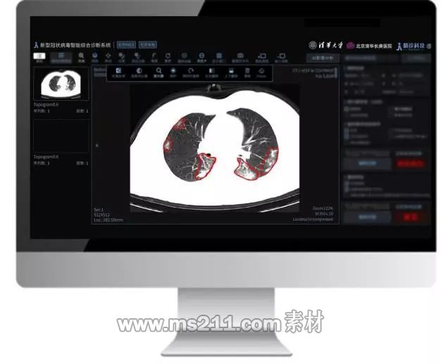 “新型冠狀病毒肺炎智能輔助診斷系統(tǒng)”演示界面。清華大學(xué)供圖